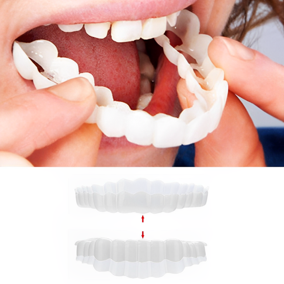 Veneers for Top and Bottom Teeth